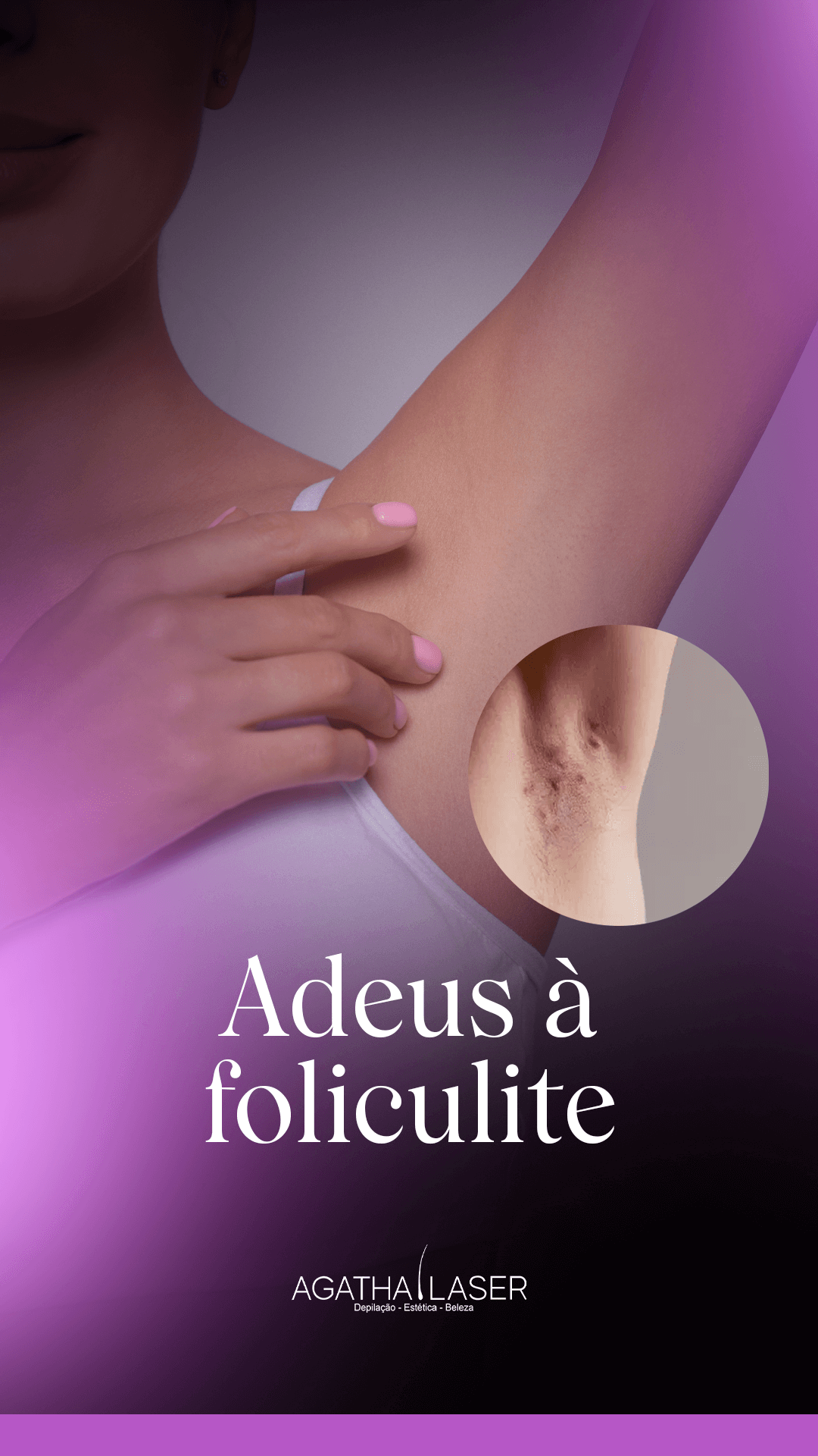adeus-foliculite